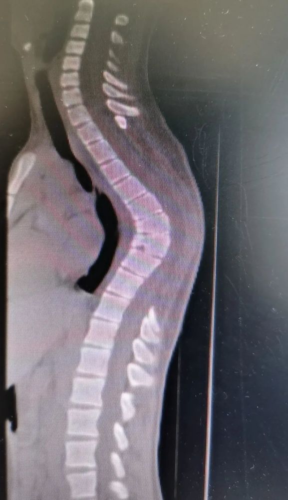 脊柱后凸70普陀医生帮男孩打开折叠人生