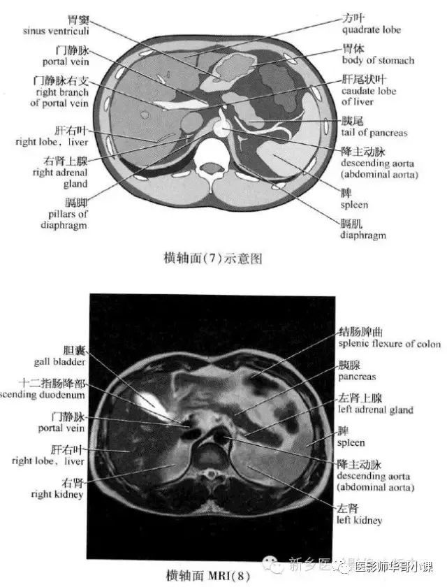 【高清mri ct图】腹部mri ct解剖 详解注释