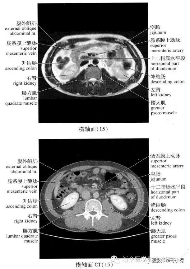 【高清mri ct图】腹部mri ct解剖 详解注释