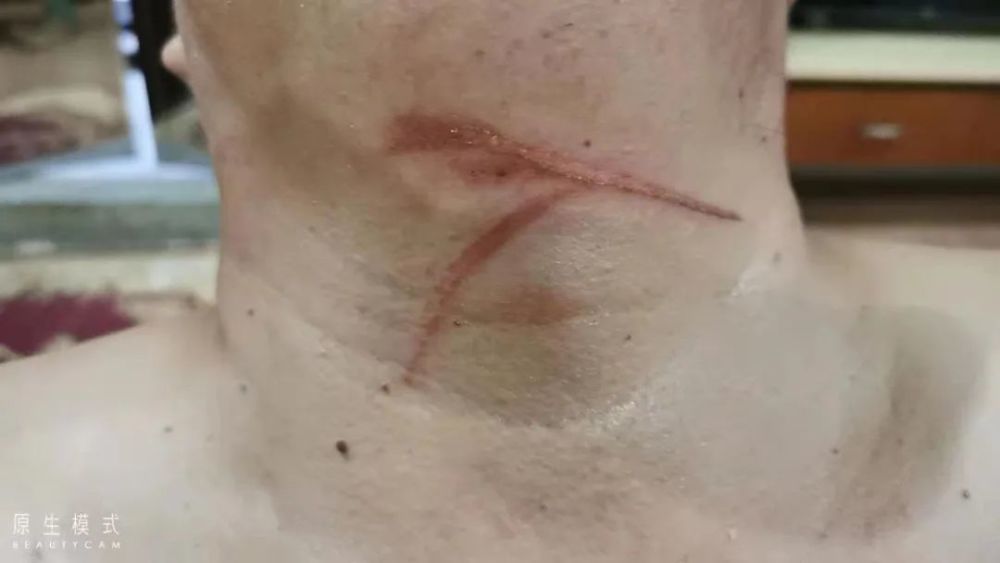 警惕男子骑车时被风筝线割伤脖子