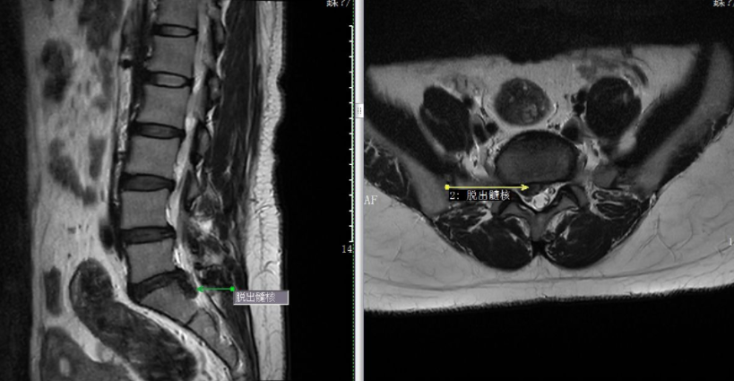 麻,卧床后下半身竟无法动弹,到医院被诊断为腰椎间盘脱出伴坐骨神经痛