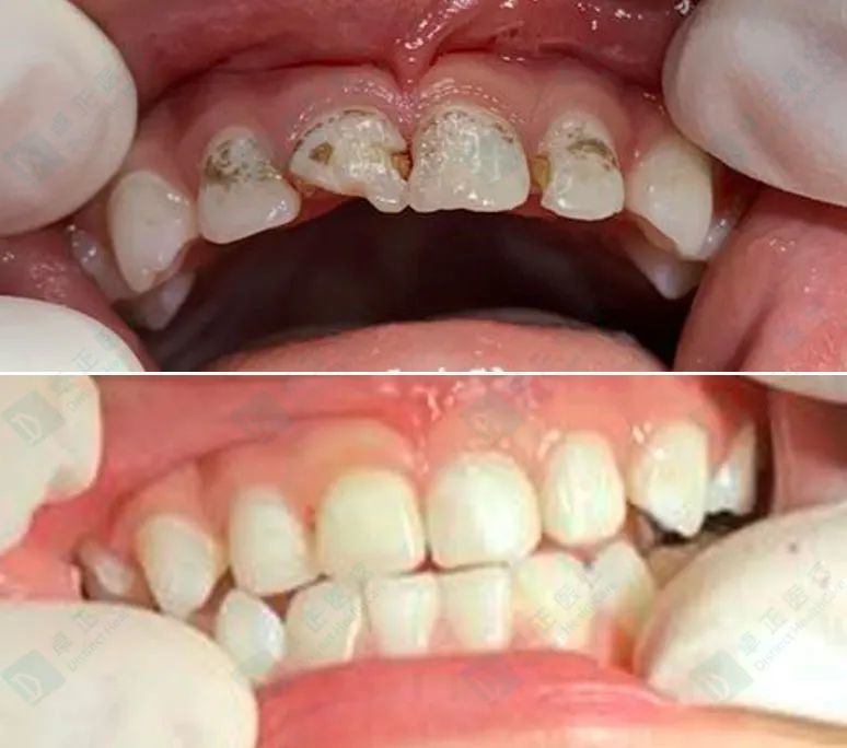 乳牙门牙龋,到底能不能补?_腾讯新闻