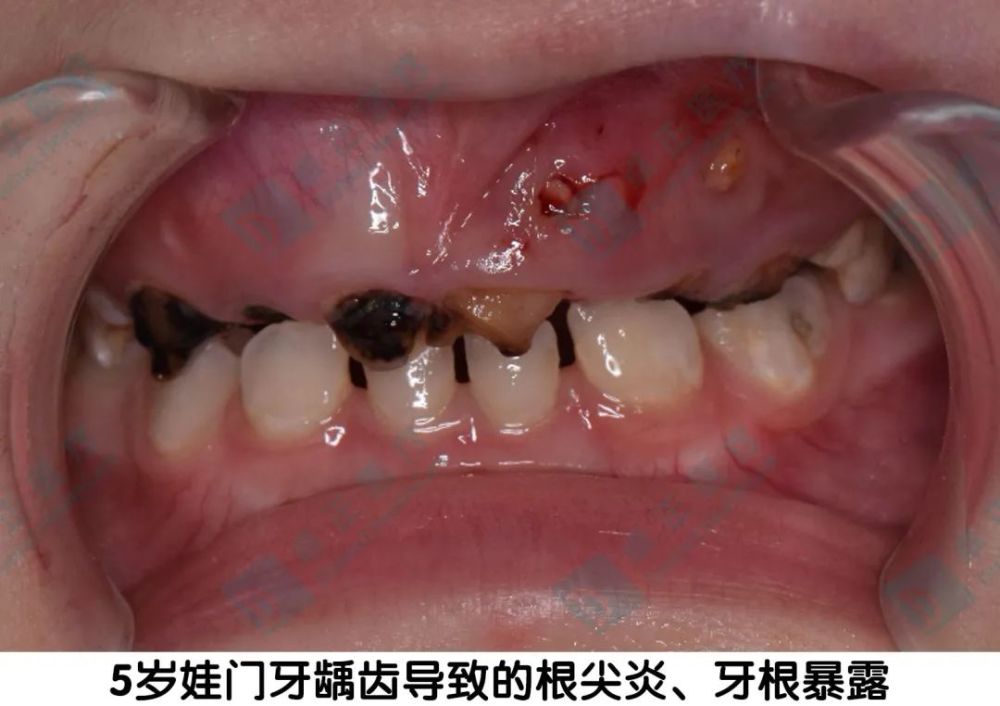 乳牙门牙龋,到底能不能补?_腾讯新闻