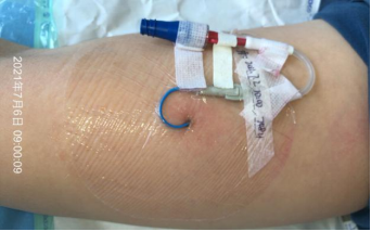 picc穿刺点出现红肿热痛这个病例值得警惕