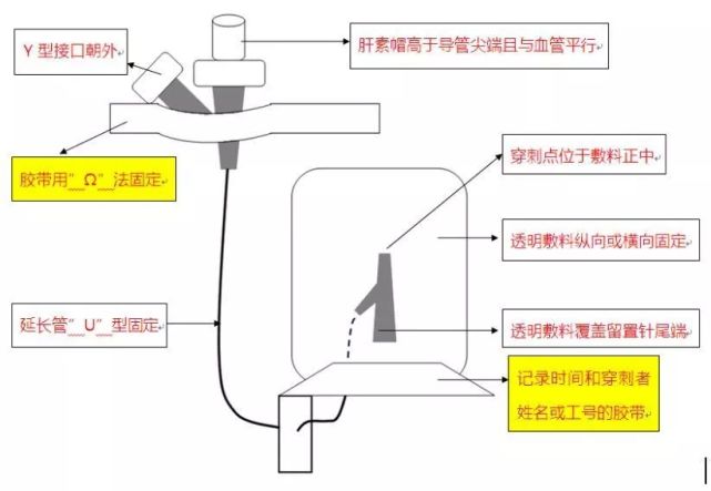 留置针高举平台法图片图片