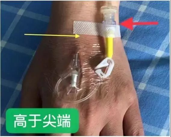 要点五记录穿刺日期时间,穿刺者工号,胶带封住留置针的隔离塞.