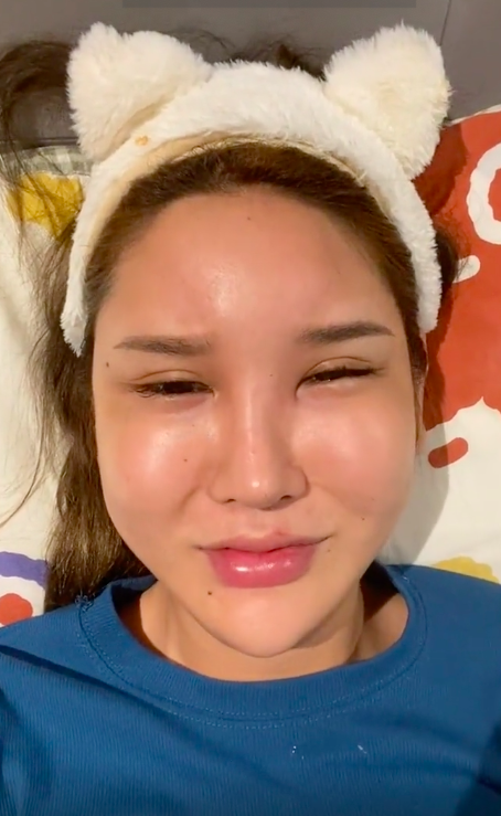 整容有风险女网红额头填充成天鹅头形状自称变成畸形一脸生不如死