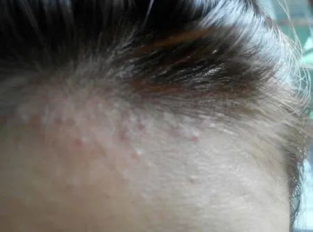 发际线长痘估计是你大意了!_腾讯新闻