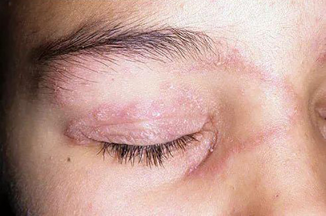 自家猫咪舔过主人有脚气的脚,然后主人又和猫咪的脸亲密接触,导致感染