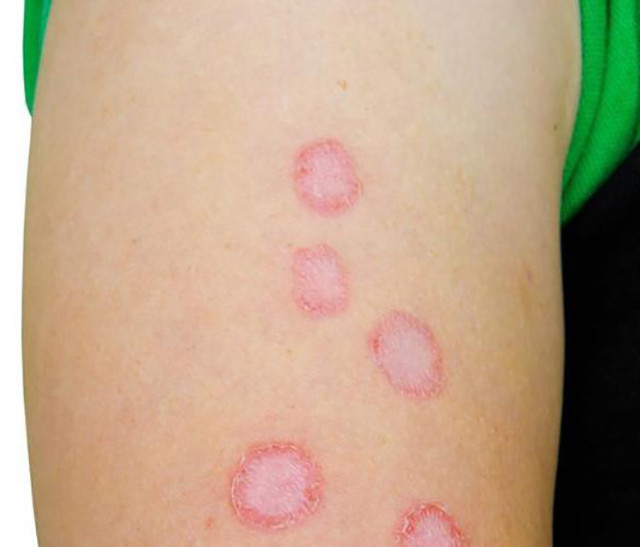 为什么我的脚气会长在脸上