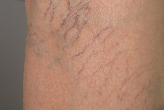 腿上青筋明显小心血管暗藏地雷