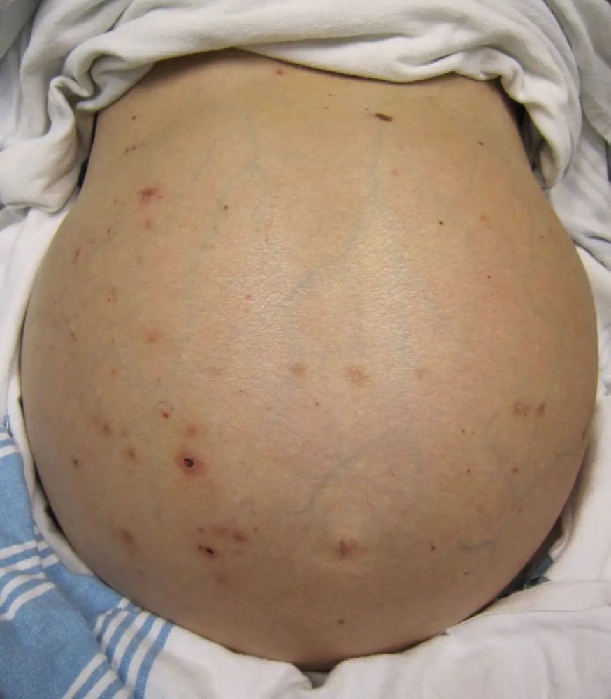 大量腹水和静脉扩张的肝硬化患者图片来源:维基百科一旦慢性丙型肝炎