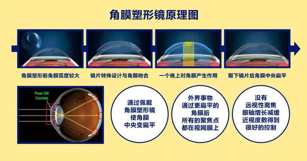 暑期又战近视,ok镜是防控神器吗?_腾讯新闻