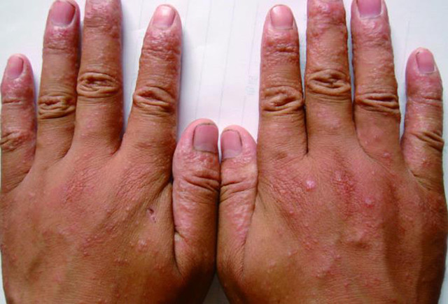 易误诊的癣菌疹