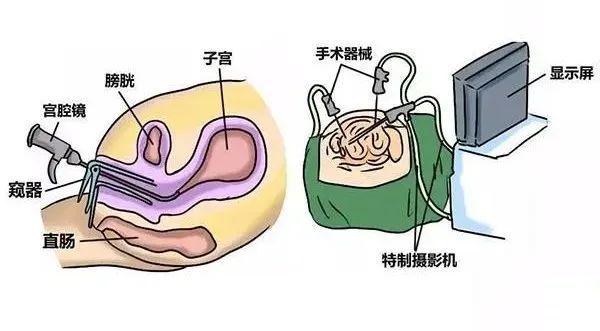 宮腔鏡和腹腔鏡到底區別在哪裡