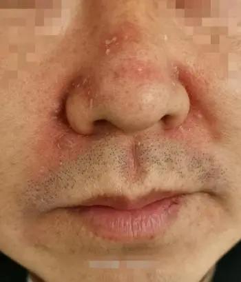 长期戴口罩皮肤发红发痒过敏怎么办药师的自用秘方送给你