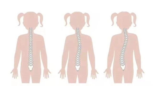 脊柱侧弯发病率图片