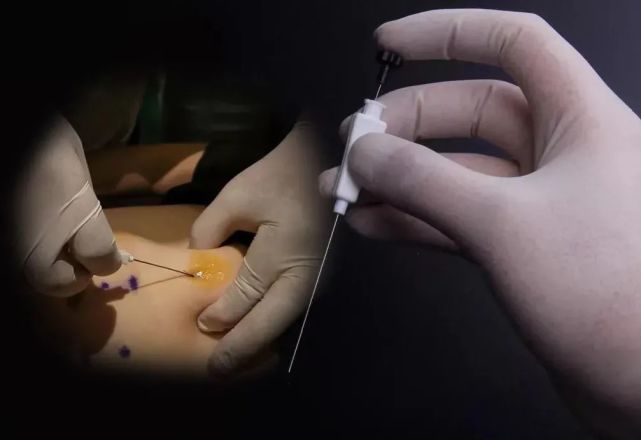 穴位埋线疗法:治疗带下症