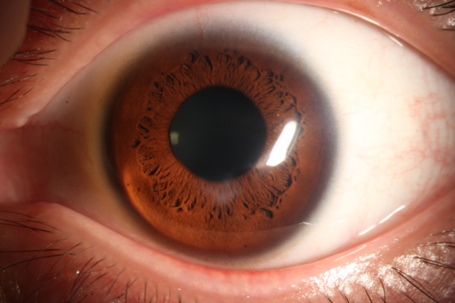 多家医院眼库助力十余名圆锥角膜学生重返校园