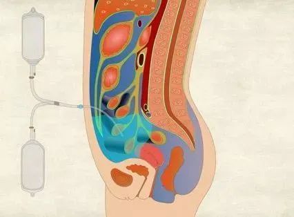 科普肾病科带您了解腹膜透析