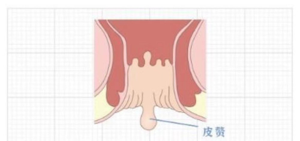 肛周软纤维瘤图片图片