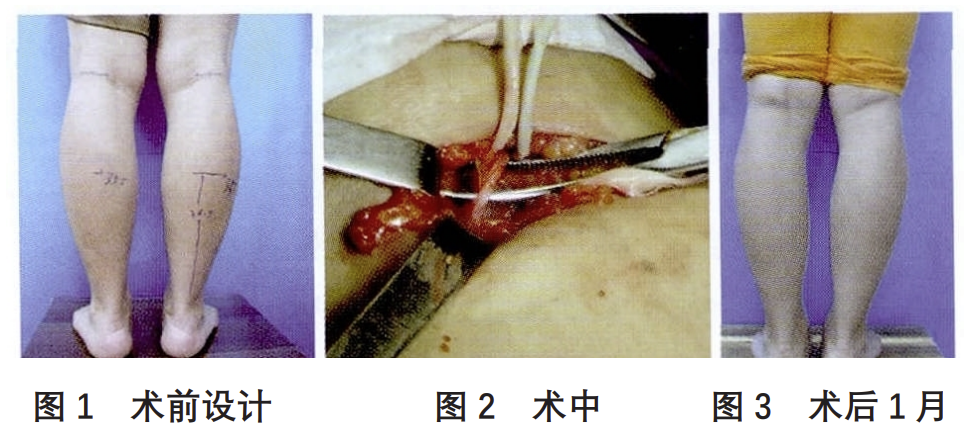 切断小腿神经以瘦腿,这一手术被国家卫健委叫停