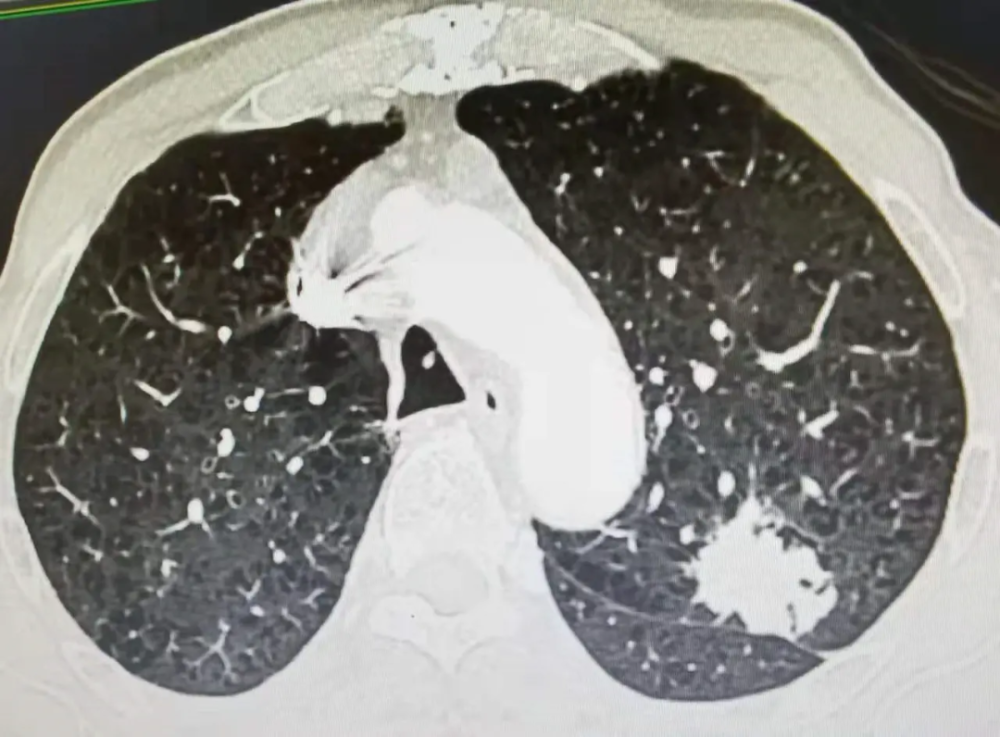 因声音嘶哑就诊发现肺腺癌晚期