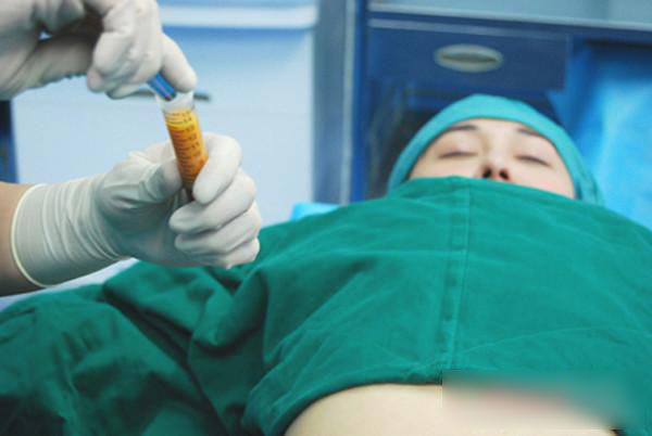 网红做抽脂手术严重感染离世丨一文读懂抽脂填充术的"前世今生"