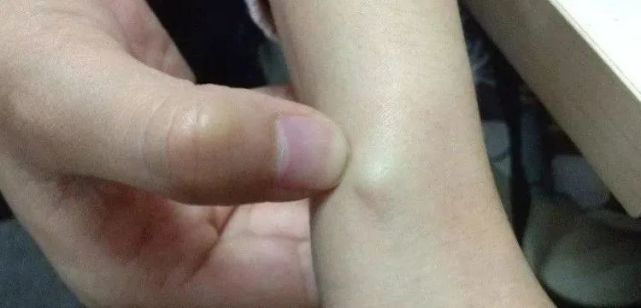 筋结不散好比地雷艾灸散结去筋疙瘩效果好拉筋艾灸散结体内百病消