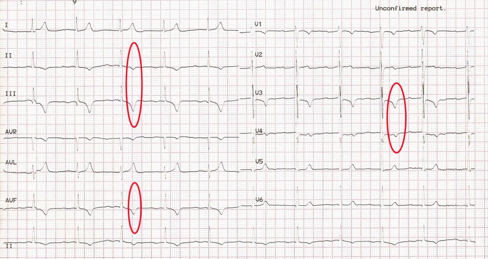 心电图t波改变是怎么回事儿?就是冠心病吗?_腾讯新闻