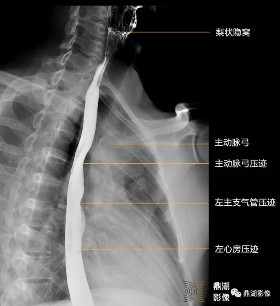 x线高清图谱食管造影解剖