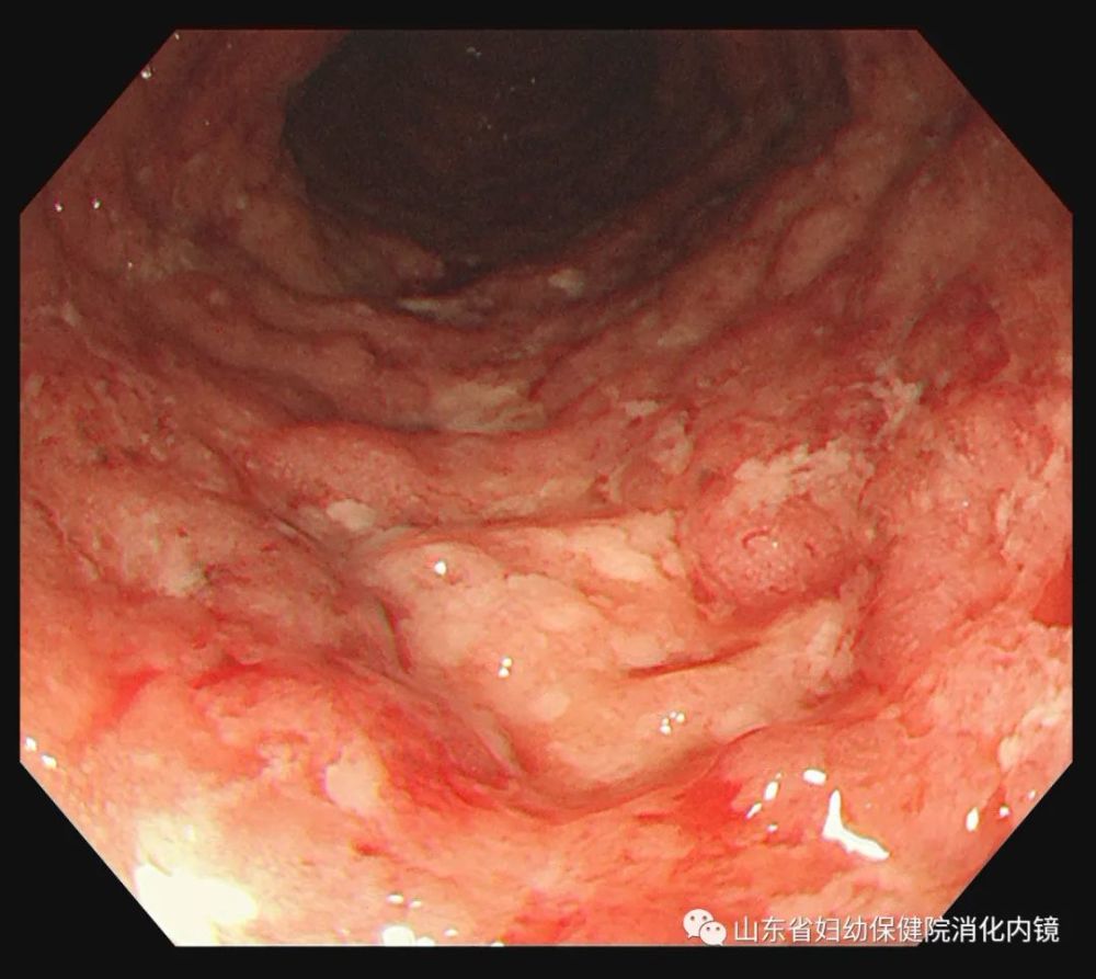 长期腹泻,便血,有可能是这种病!_腾讯新闻