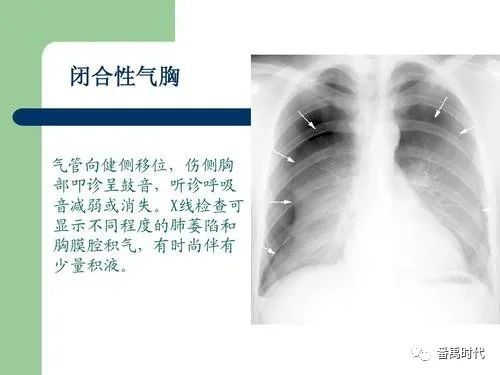 气胸的临床症状有哪些特点_腾讯新闻