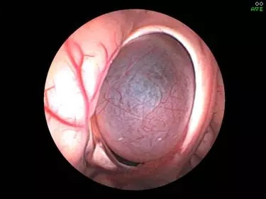 蛛网膜囊肿有哪几种手术治疗方式?