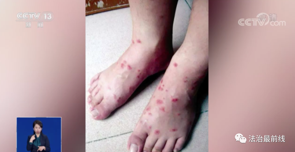 一女子被蚂蚁咬伤不治身亡!看到这种小红土堆,赶紧躲远点_腾讯新闻