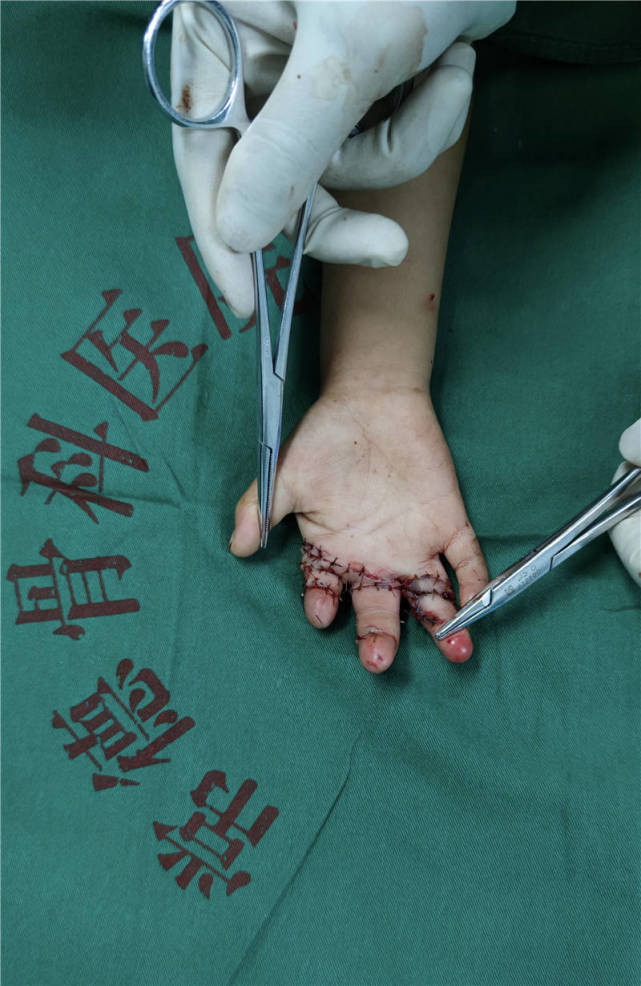 扎心!4岁男童被电动剁猪草机"咬掉"三个手指