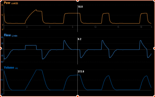插管时氧分压仍急剧下降?原来是漏看了呼吸机波形!_腾讯新闻