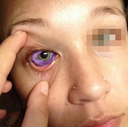 国外一女子,哭出来的是紫色眼泪,医生查出真相原因是纹身