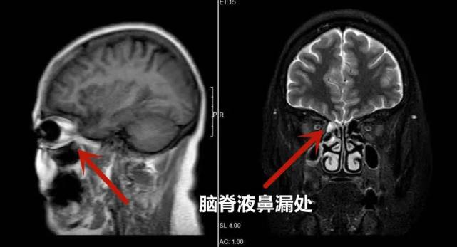 惠州一女性感冒多月以为流鼻涕实则脑脊液漏了
