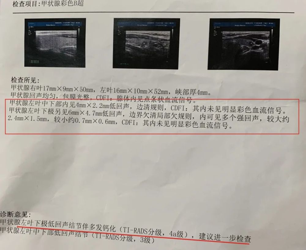 甲状腺结节"钙化"距离癌症还有多远?