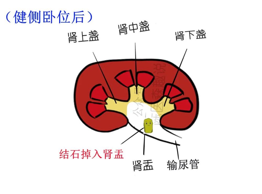 肾下盏的结石很难排出?一定要试试这个方法