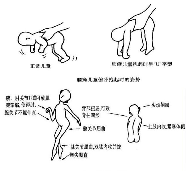 腦癱兒的智力一定低嗎家長不瞭解的腦癱疾病5大誤區