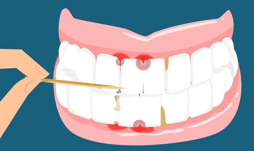 闫燕医生:经常剔牙对牙齿有什么危害?