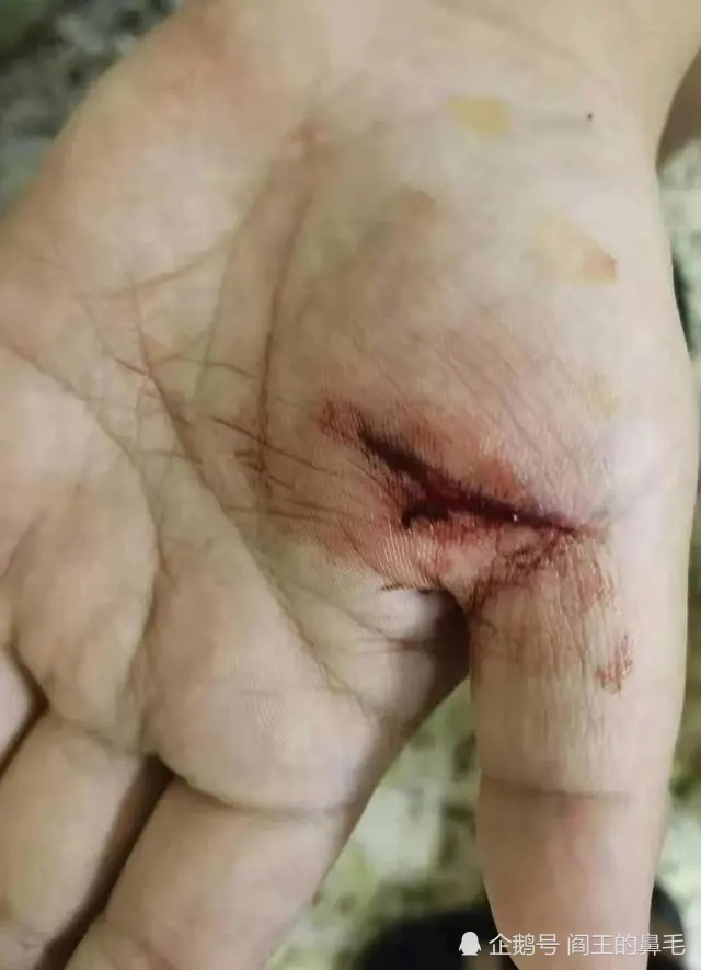 游泳馆瓷片割烂11岁男孩手掌缝7针,店家态度蛮横强硬