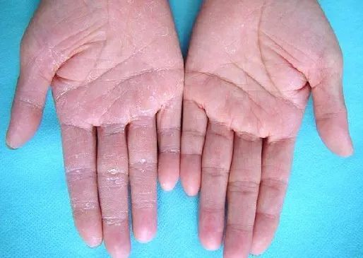 硬皮病(scleroderma)是臨床上以局灶性或瀰漫性皮膚增厚和纖維化為