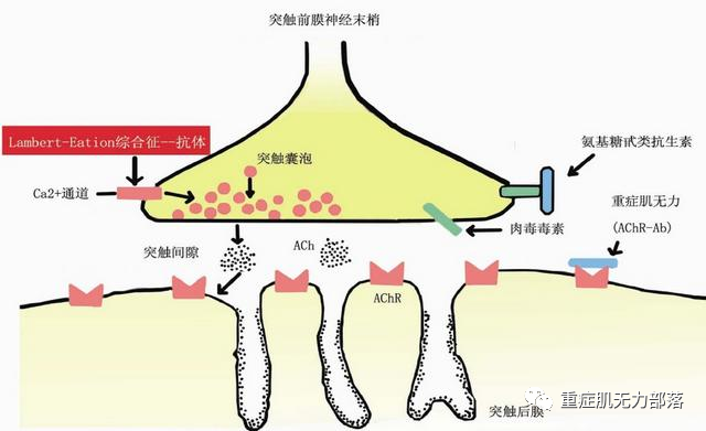 重症肌無力的這4個問題你也疑惑嗎