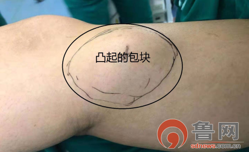 经拍片检查后诊断为"胫骨近端骨软骨瘤"于是住院准备行手术切除治疗