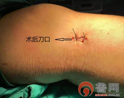 经拍片检查后诊断为"胫骨近端骨软骨瘤"于是住院准备行手术切除治疗