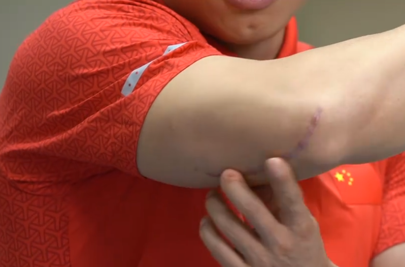 对于举重运动员来说,这个伤预示着这块肌肉不能正常发力了,谌利军因此