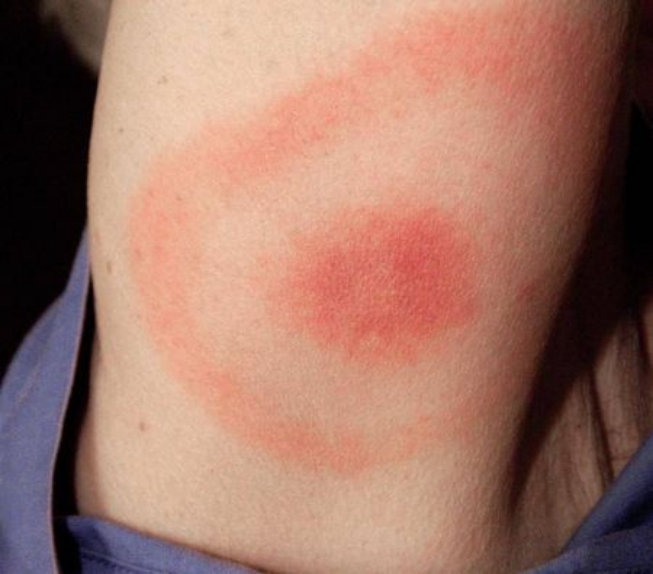 出现红斑,也有可能进一步发展成丘疹或瘤状突起,或引起皮炎或过敏反应
